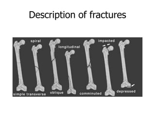 Description of fractures
 