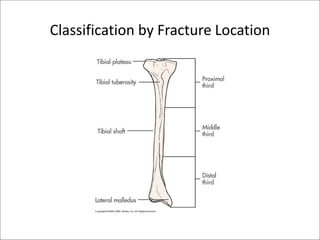 Classification by Fracture Location
 