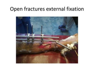 Open fractures external fixation
 