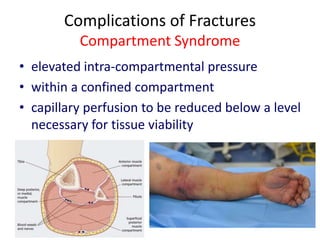 Complications of Fractures
Compartment Syndrome
• elevated intra-compartmental pressure
• within a confined compartment
• capillary perfusion to be reduced below a level
necessary for tissue viability
 