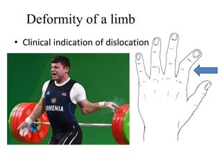 Deformity of a limb
• Clinical indication of dislocation
 