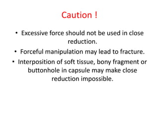Caution !
• Excessive force should not be used in close
reduction.
• Forceful manipulation may lead to fracture.
• Interposition of soft tissue, bony fragment or
buttonhole in capsule may make close
reduction impossible.
 