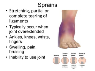 Sprains
• Stretching, partial or
complete tearing of
ligaments
• Typically occur when
joint overextended
• Ankles, knees, wrists,
fingers
• Swelling, pain,
bruising
• Inability to use joint
 