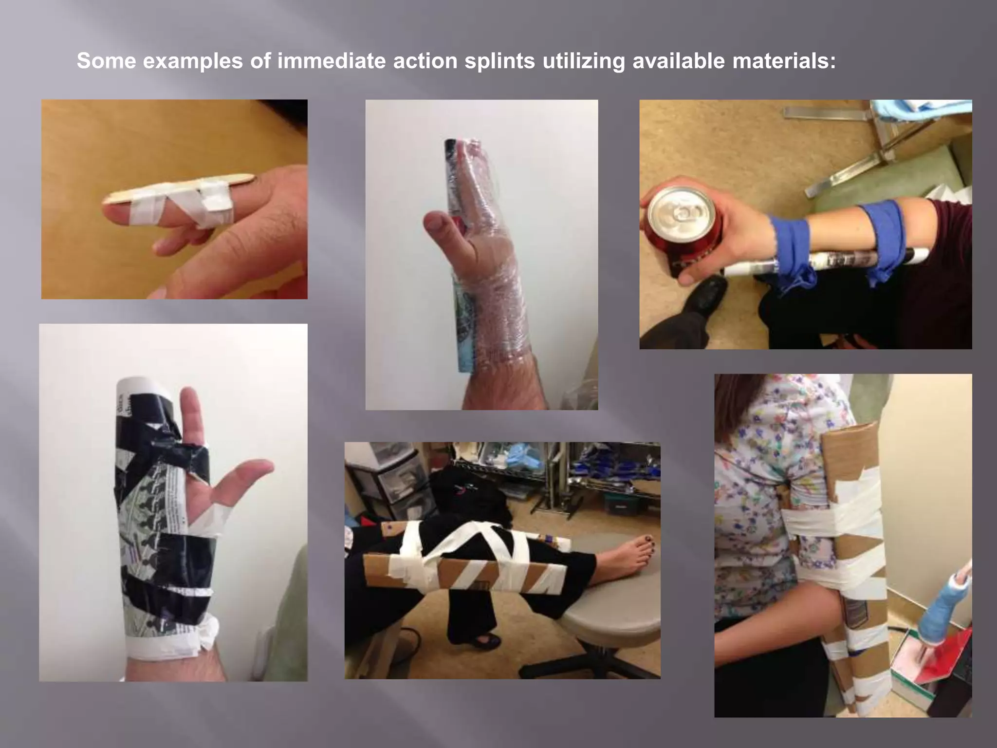 Orthopedic splinting | PPTX