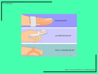 Thumb Spica
Indication:
• Gamekeeper's thumb
• Osteoarthritis
• de Quervain's syndrome
 