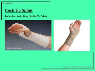 Dynamic Cock Up Splint
Indication: Wrist Drop (Radial Nv Palsy)
 