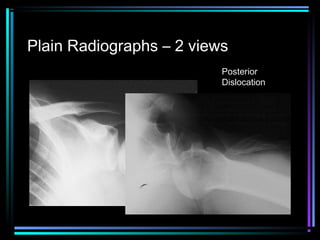 Plain Radiographs – 2 views
Posterior
Dislocation

 