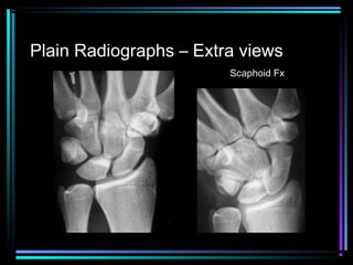 Plain Radiographs – Extra views
Scaphoid Fx

 