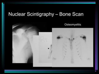 Nuclear Scintigraphy – Bone Scan
Osteomyelitis

 