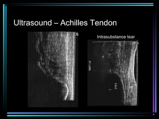Ultrasound – Achilles Tendon
Intrasubstance tear

 