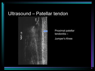 Ultrasound – Patellar tendon

Proximal patellar
tendonitis –
Jumper’s Knee

 