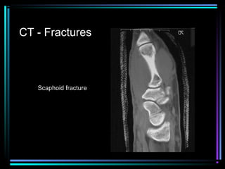 CT - Fractures

Scaphoid fracture

 
