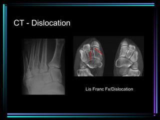 CT - Dislocation

Lis Franc Fx/Dislocation

 
