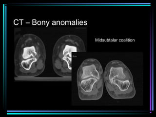 CT – Bony anomalies
Midsubtalar coalition

 
