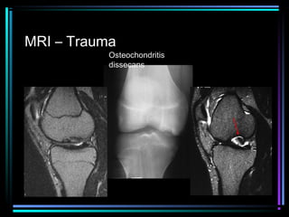 MRI – Trauma

Osteochondritis
dissecans

 