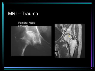 MRI – Trauma
Femoral Neck
Fracture

 