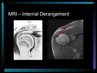 MRI – Internal Derangement

 