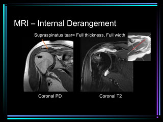 MRI – Internal Derangement
Supraspinatus tear= Full thickness, Full width

Coronal PD

Coronal T2

 