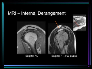MRI – Internal Derangement

Sagittal NL

Sagittal FT, FW Supra

 