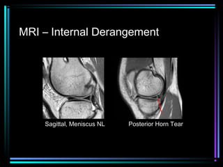 MRI – Internal Derangement

Sagittal, Meniscus NL

Posterior Horn Tear

 