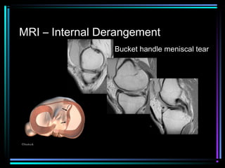 MRI – Internal Derangement
Bucket handle meniscal tear

 