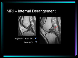 MRI – Internal Derangement

Sagittal – Intact ACL
Torn ACL

 