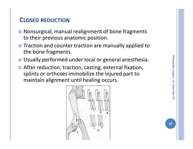 Orthopedic surgery 2nd general principles in fractures | PPT