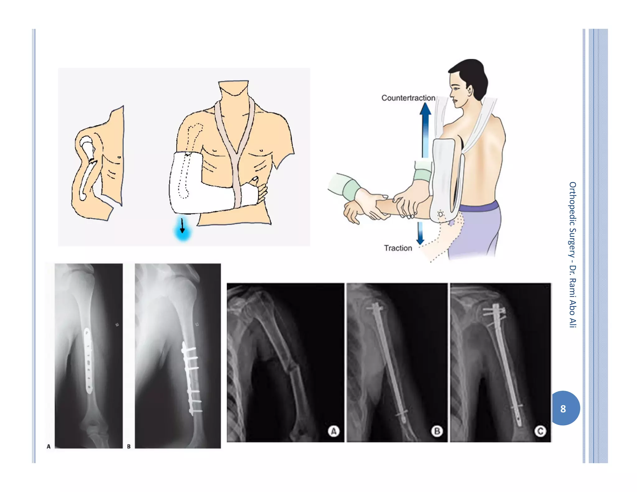 Orthopedic surgery 5th injuries to the upper limb ( 2 ) | PDF