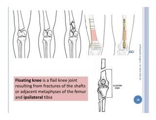 Ipsilateral Tibia Orthopedic surgery 8th injuries to the lower limb ( 2 ) | PDF
