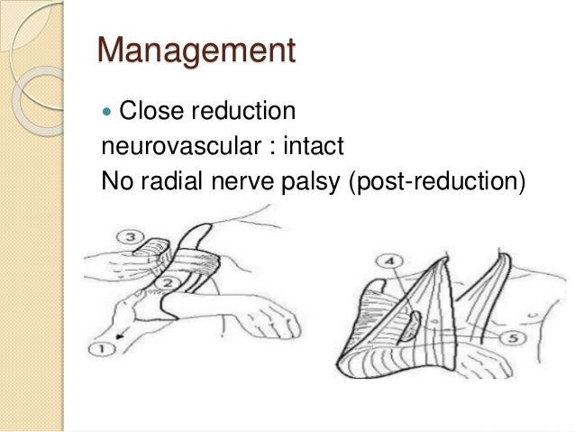 Orthopedic teleconference mnrh ext montakarn_Humeral shaft fracture