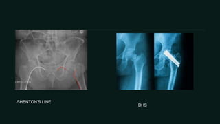 fracture of neck of femur | PPTX