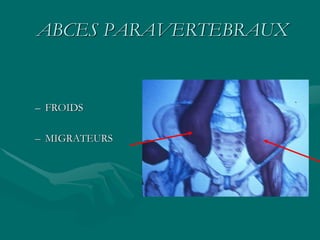 ABCES PARAVERTEBRAUX
– FROIDS
– MIGRATEURS
 