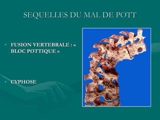 SEQUELLES DU MAL DE POTT
• FUSION VERTEBRALE : «
BLOC POTTIQUE »
• CYPHOSE
 