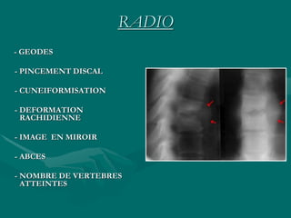 RADIO
- GEODES
- PINCEMENT DISCAL
- CUNEIFORMISATION
- DEFORMATION
RACHIDIENNE
- IMAGE EN MIROIR
- ABCES
- NOMBRE DE VERTEBRES
ATTEINTES
 