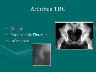 Arthrites TBC
• Fléxum
• Pincement de l’interligne
• ostéoporose
 