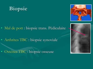 Biopsie
• Mal de pott : biopsie trans. Pédiculaire
• Arthrites TBC : biopsie synoviale
• Ostéites TBC : biopsie osseuse
 