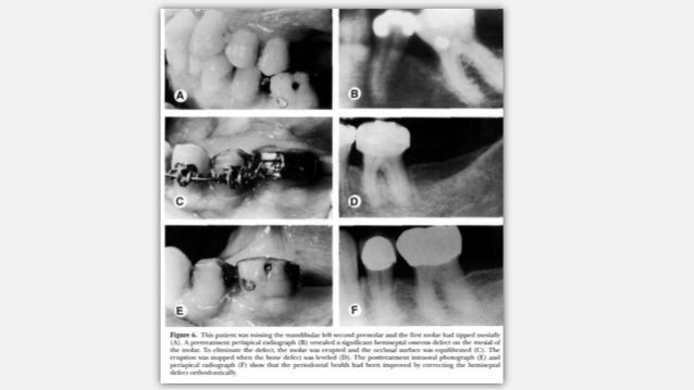 periodontal orthodontic patient