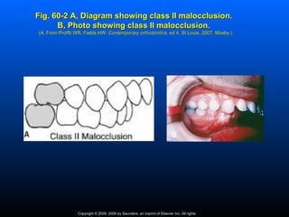 Fig. 60-2 A, Diagram showing class II malocclusion.
      B, Photo showing class II malocclusion.
(A, From Proffit WR, Fields HW: Contemporary orthodontics, ed 4, St Louis, 2007, Mosby.)
                                             orthodontics,




                                                                           B




                 Copyright © 2009, 2006 by Saunders, an imprint of Elsevier Inc. All rights
 