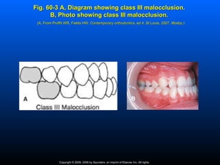 Fig. 60-3 A, Diagram showing class III malocclusion.
      B, Photo showing class III malocclusion.
 (A, From Proffit WR, Fields HW: Contemporary orthodontics, ed 4, St Louis, 2007, Mosby.)
                                              orthodontics,




                                                                         B




              Copyright © 2009, 2006 by Saunders, an imprint of Elsevier Inc. All rights
 