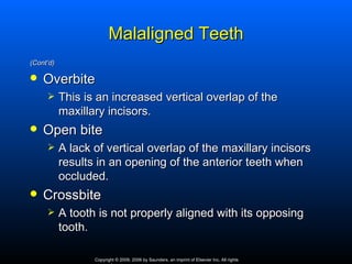 Malaligned Teeth
(Cont’d)

   Overbite
          This is an increased vertical overlap of the
           maxillary incisors.
   Open bite
          A lack of vertical overlap of the maxillary incisors
           results in an opening of the anterior teeth when
           occluded.
   Crossbite
          A tooth is not properly aligned with its opposing
           tooth.

                  Copyright © 2009, 2006 by Saunders, an imprint of Elsevier Inc. All rights
 