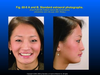 Fig. 60-9 A and B, Standard extraoral photographs.
             (From Proffit WR, Fields H, Sarver DM: Contemporary
                  orthodontics, ed 4, St Louis, 2007, Mosby.)
                  orthodontics,




        Copyright © 2009, 2006 by Saunders, an imprint of Elsevier Inc. All rights
 