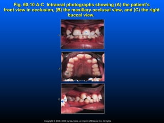 Fig. 60-10 A-C Intraoral photographs showing (A) the patient’s
front view in occlusion, (B) the maxillary occlusal view, and (C) the right
                               buccal view.




                   Copyright © 2009, 2006 by Saunders, an imprint of Elsevier Inc. All rights
 