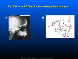 Fig. 60-11 A and B Cephalometric radiograph and analysis.




A                                                               B




               Copyright © 2009, 2006 by Saunders, an imprint of Elsevier Inc. All rights
 