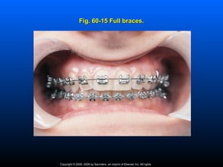 Fig. 60-15 Full braces.




Copyright © 2009, 2006 by Saunders, an imprint of Elsevier Inc. All rights
 