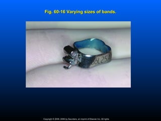 Fig. 60-16 Varying sizes of bands.




Copyright © 2009, 2006 by Saunders, an imprint of Elsevier Inc. All rights
 