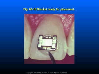 Fig. 60-18 Bracket ready for placement.




  Copyright © 2009, 2006 by Saunders, an imprint of Elsevier Inc. All rights
 