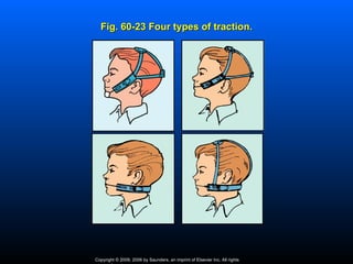 Fig. 60-23 Four types of traction.




Copyright © 2009, 2006 by Saunders, an imprint of Elsevier Inc. All rights
 