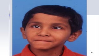 Optom. Ankit Varshney 21
 