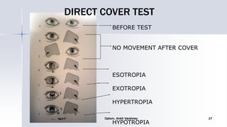BEFORE TEST
NO MOVEMENT AFTER COVER
ESOTROPIA
EXOTROPIA
HYPERTROPIA
HYPOTROPIA
DIRECT COVER TEST
Optom. Ankit Varshney 27
 