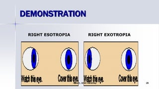 RIGHT ESOTROPIA RIGHT EXOTROPIA
DEMONSTRATION
Optom. Ankit Varshney 28
 